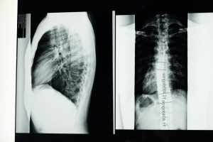 CrossFit y dolor lumbar: causas y cómo prevenirlo